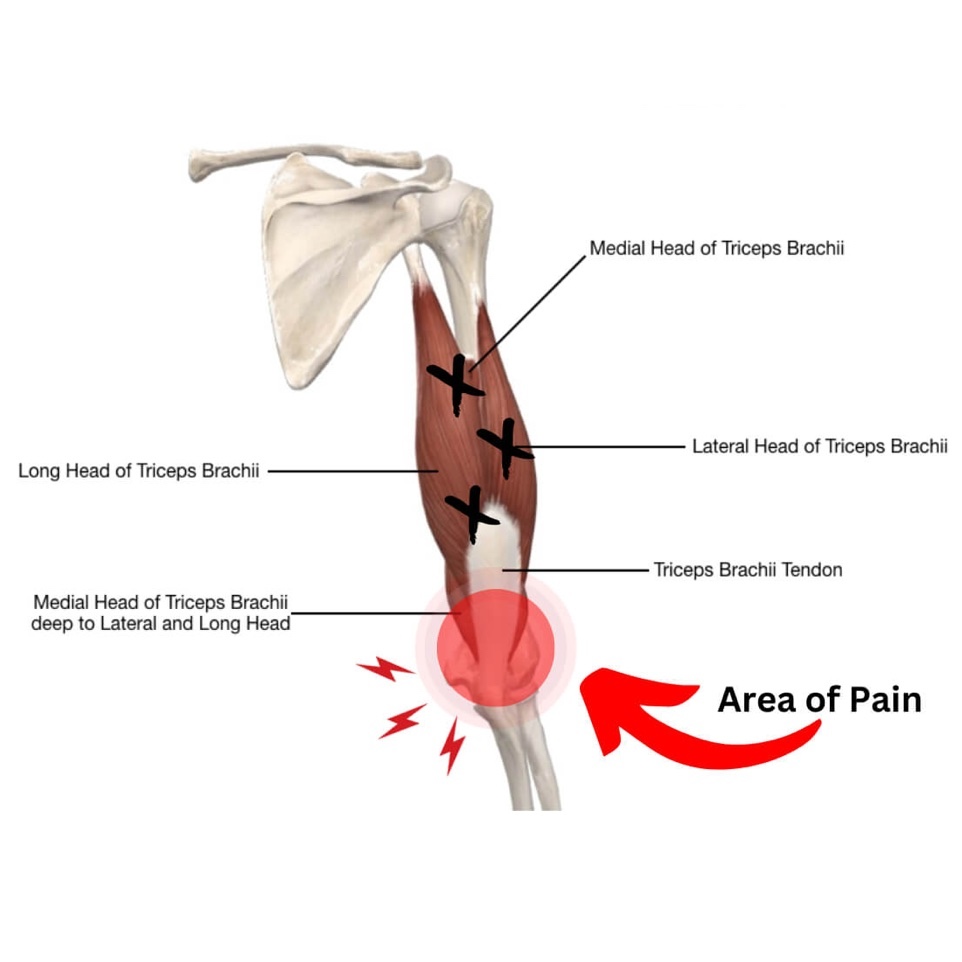Diagram of the triceps tendon junction illustrating heavy isometric and isotonic loading protocols for posterior elbow pain