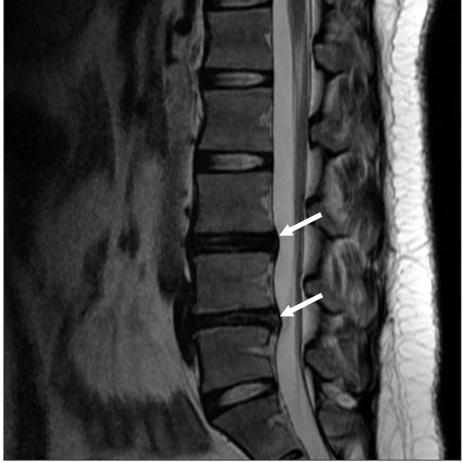 MRI scan demonstrating a slipped disc in the lower back, a common musculoskeletal condition managed through evidence-based active rehabilitation in Singapore.