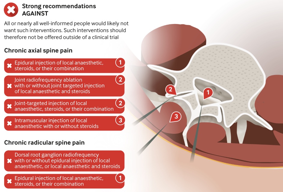 Summary table from the BMJ clinical practice guideline showing strong recommendations against common spinal interventions, including radiofrequency ablation and epidural injections, for chronic axial and radicular pain.