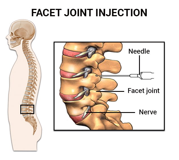 facet-joint-block-injection-low-back-pain - Square One Active Recovery Diagram showing a needle delivering a facet joint injection into the spinal joint capsule of the lumbar spine for lower back pain relief.
