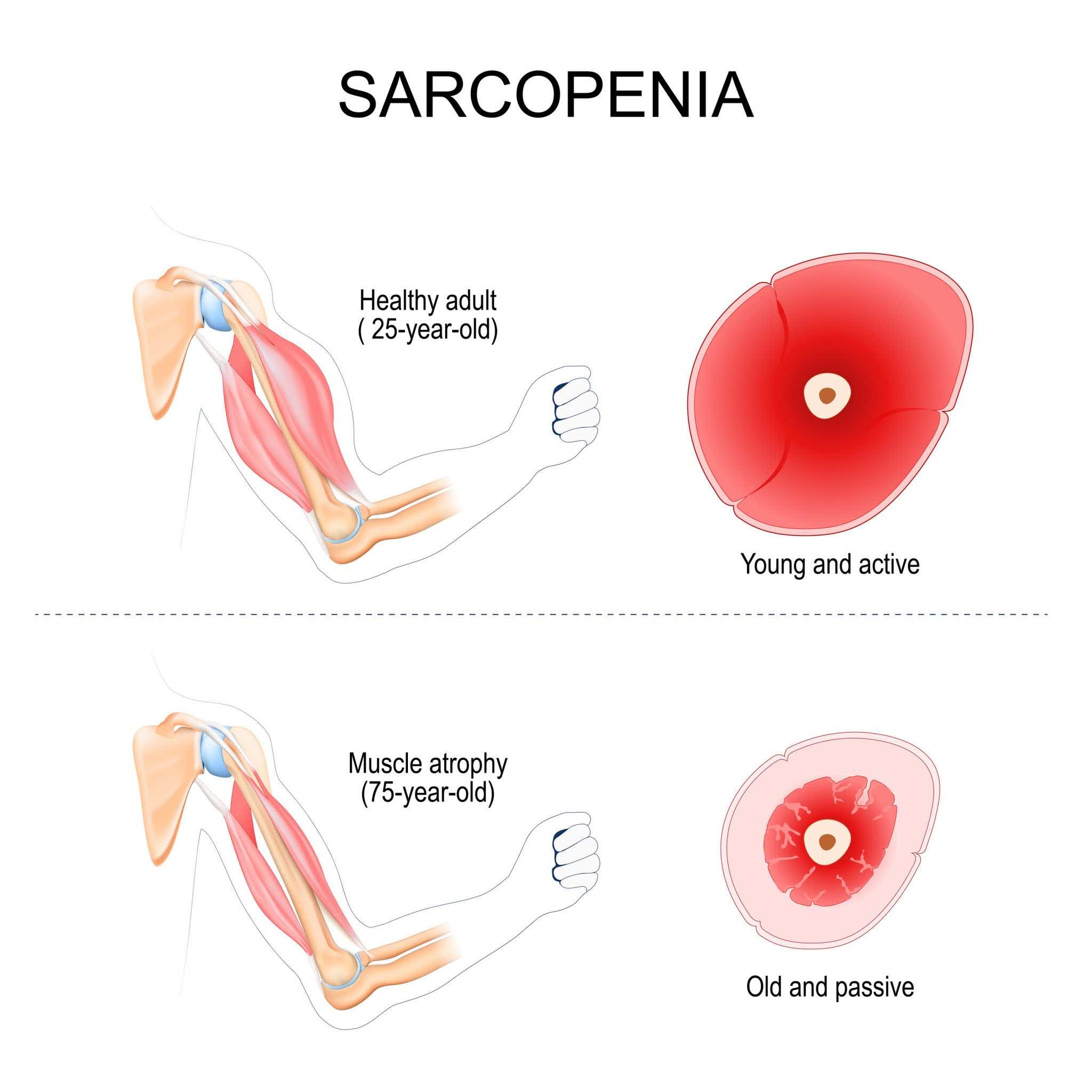 Cross section diagram comparing a healthy active arm with a sarcopenic muscle atrophy arm