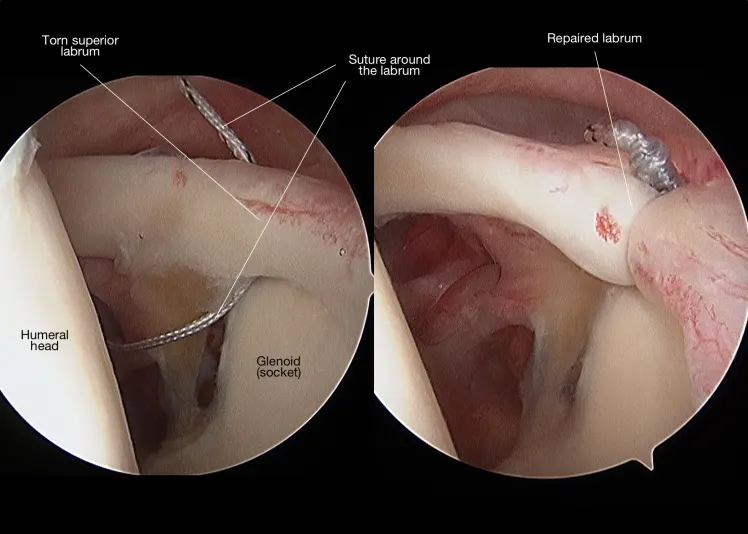Arthroscopic intraoperative view of a torn labrum being reattached to the socket rim using suture anchors.