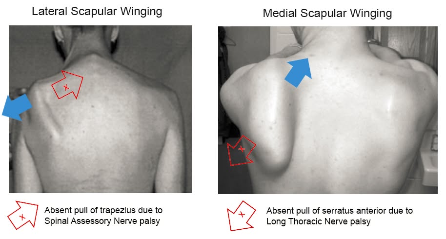 Clinical photograph comparing medial scapular winging with the shoulder blade lifting inward against lateral scapular winging with the shoulder blade shifting outward.