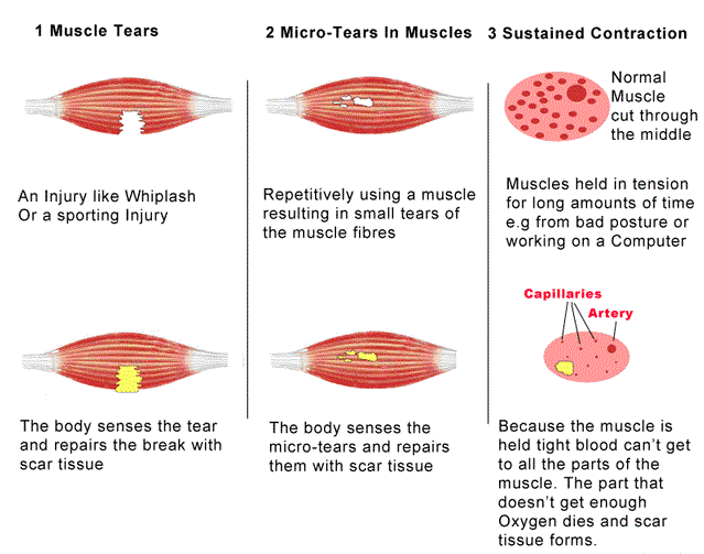 Medical illustration comparing healthy muscle fibers, microscopic muscle microtears, tight hypertonic muscles, and structural muscle tears.