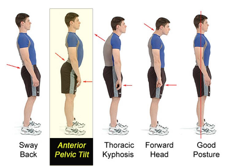 Anatomy diagram comparing standing posture variations including anterior pelvic tilt, sway back, thoracic kyphosis, forward head posture, and neutral spinal alignment.
